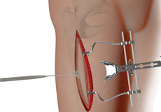 Complex Hip Reconstruction Surgery