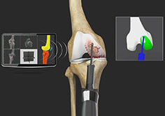 Mako Robotic-Arm Assisted Technology for partial knee replacement