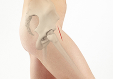 Anterior Hip Replacement