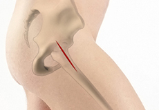 Outpatient Anterior Approach Hip Replacement