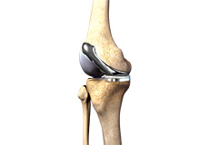 Custom-fitted Total Knee Arthroplasty