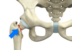 Femoral Neck Fracture