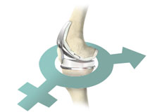 Gender-Specific Knee Replacement