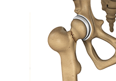 Hip Fracture Surgery