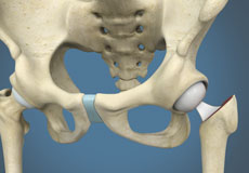 Hip Hemiarthroplasty