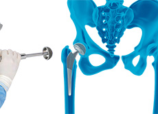 Mako SmartRobotics for Total Hip Replacement