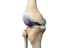 Partial Medial Knee Replacement