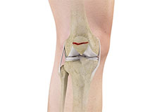 Patella Fracture