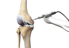 Mako Robotic-Arm Assisted Technology for total knee replacement